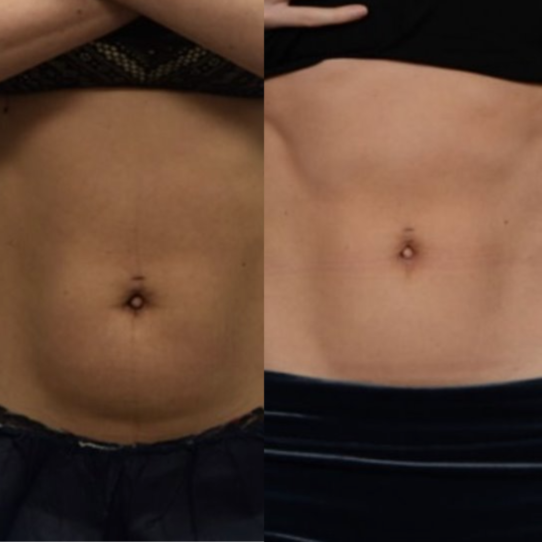 Before and after images of abdominal muscle definition following BodyTone treatments.