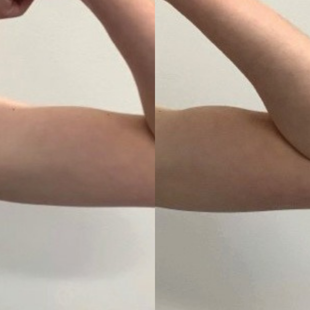 Before and after images of upper arm toning with BodyTone muscle stimulation treatment.