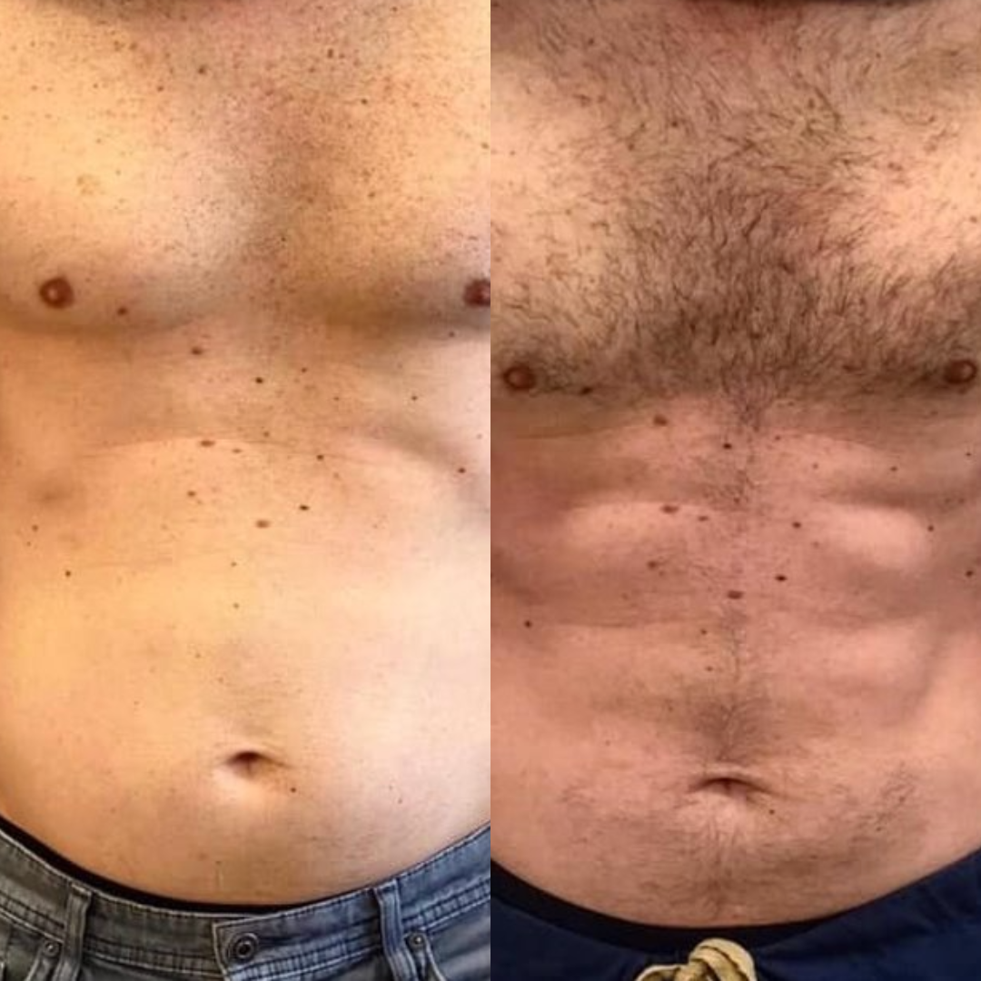 Before and after images of improved abdominal muscle tone in a male patient using BodyTone.