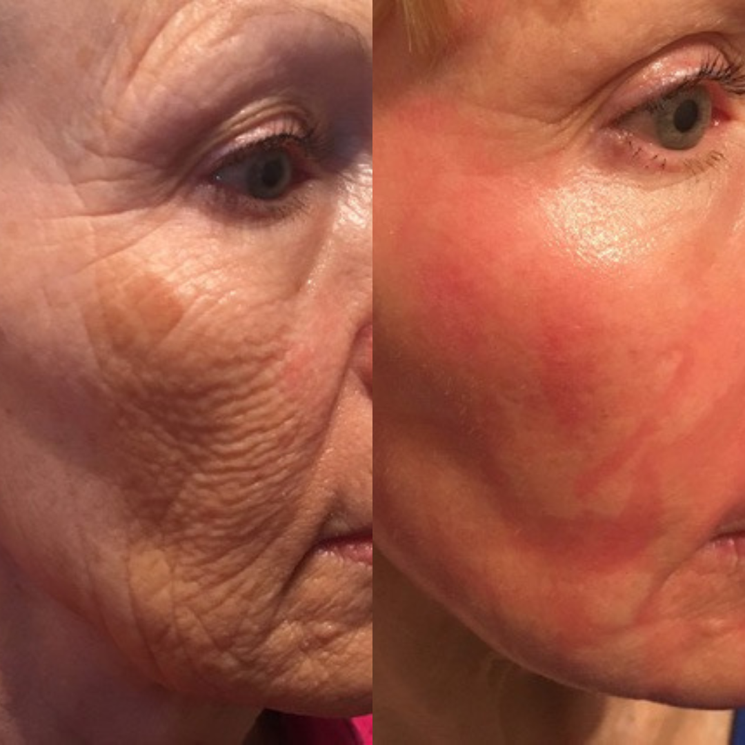 Before and after close-up images of the cheek showing diminished wrinkles and enhanced skin tone after laser skin rejuvenation.