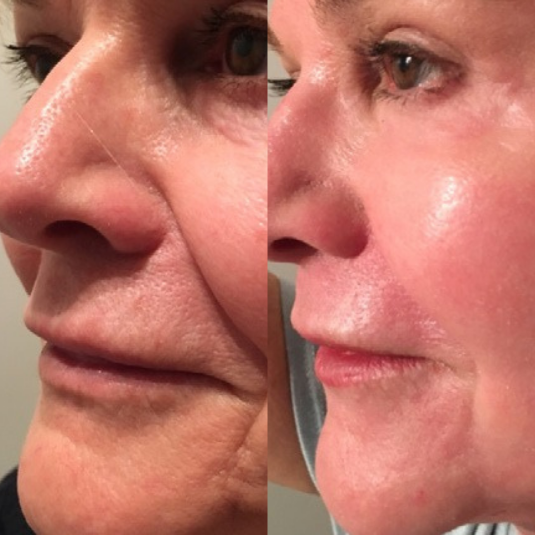 Before and after side profile images highlighting wrinkle reduction and smoother skin texture following facial laser resurfacing.