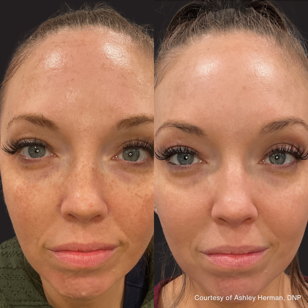 Before and after front-facing images showing clearer skin, reduced pigmentation, and improved complexion following PicoLazer treatment.