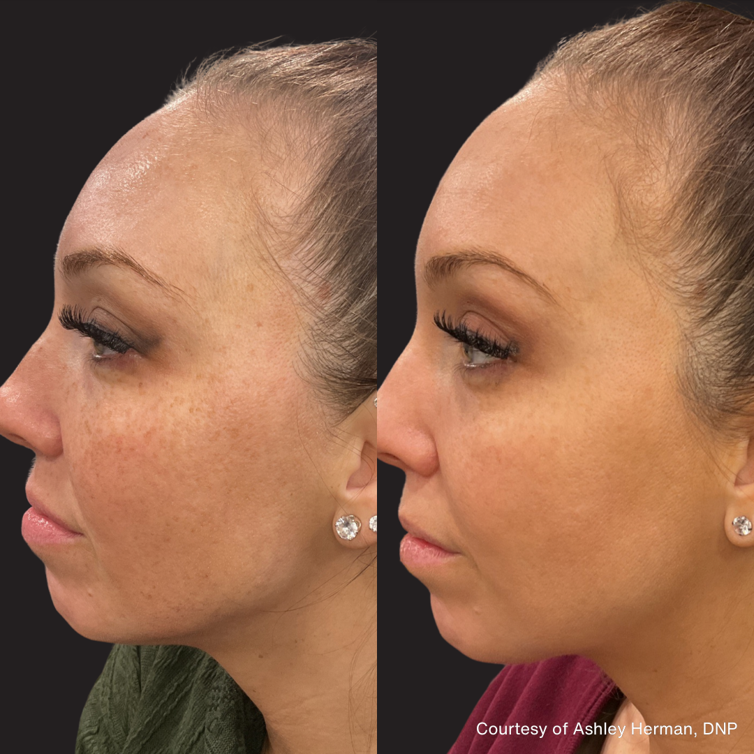 Before and after side profile images showing improved skin tone and reduced pigmentation on the face following PicoLazer treatment.