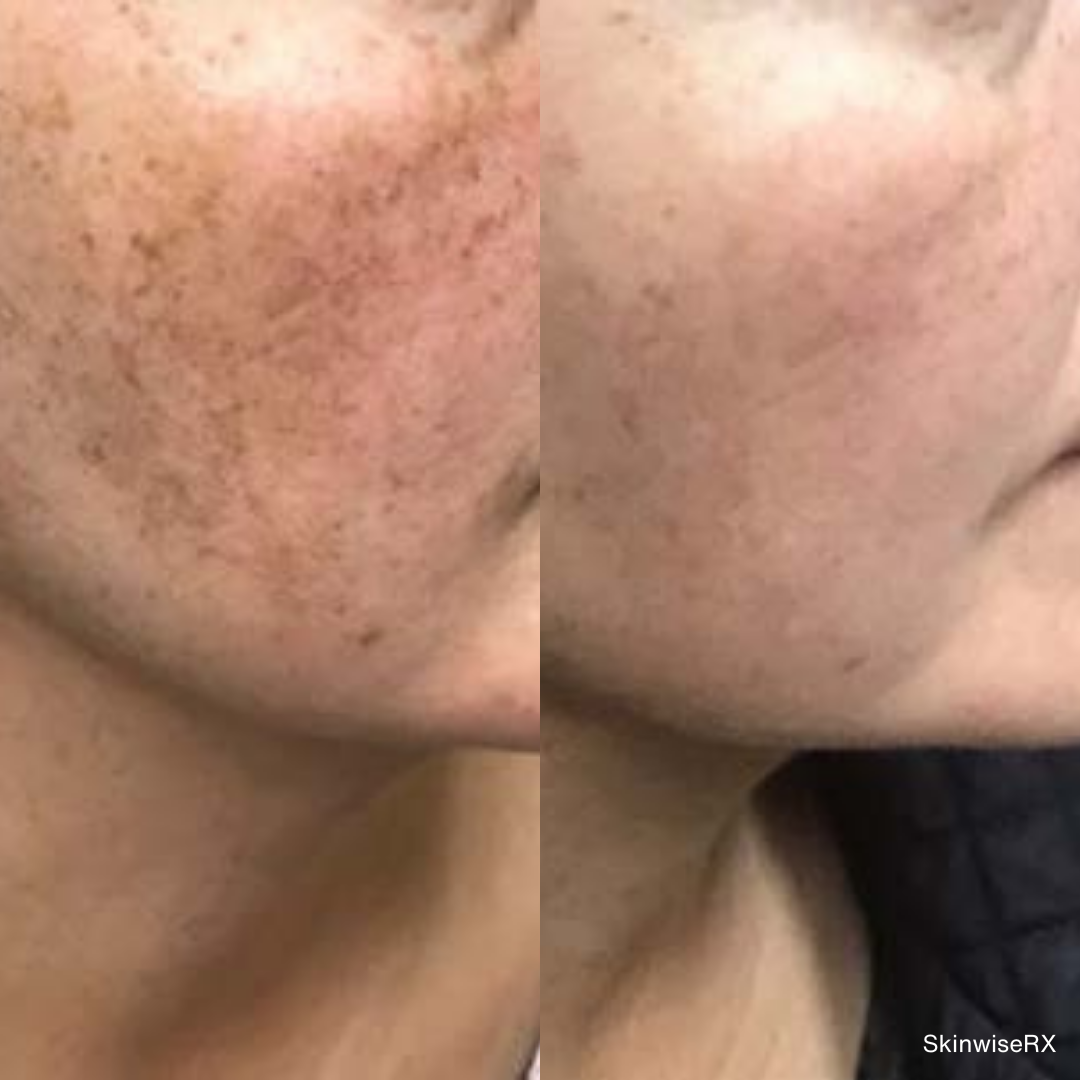 Before and after images showing clearer skin and reduced facial pigmentation following PicoLazer treatment.