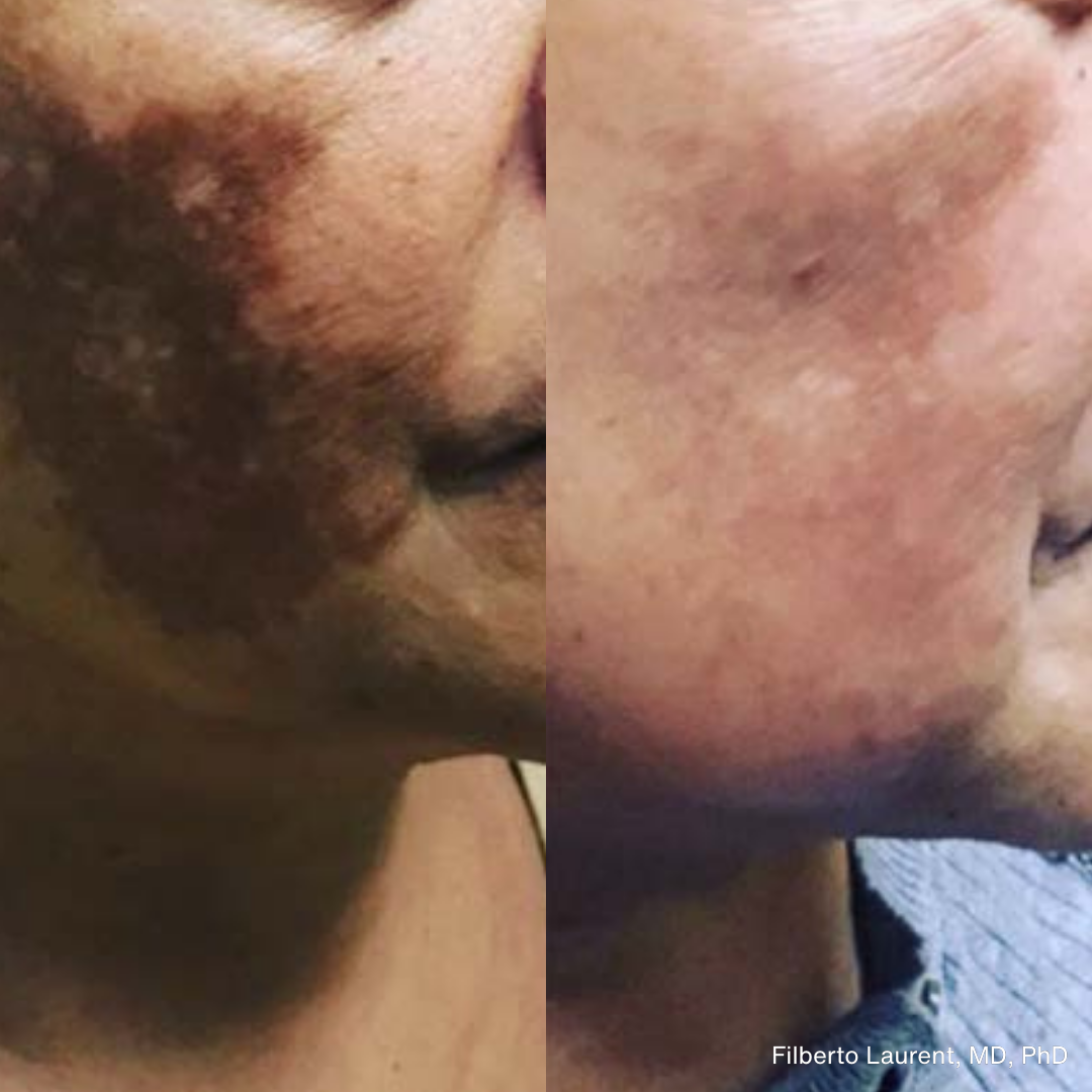 Before and after images showing significant reduction in facial pigmentation and dark spots following PicoLazer treatment.