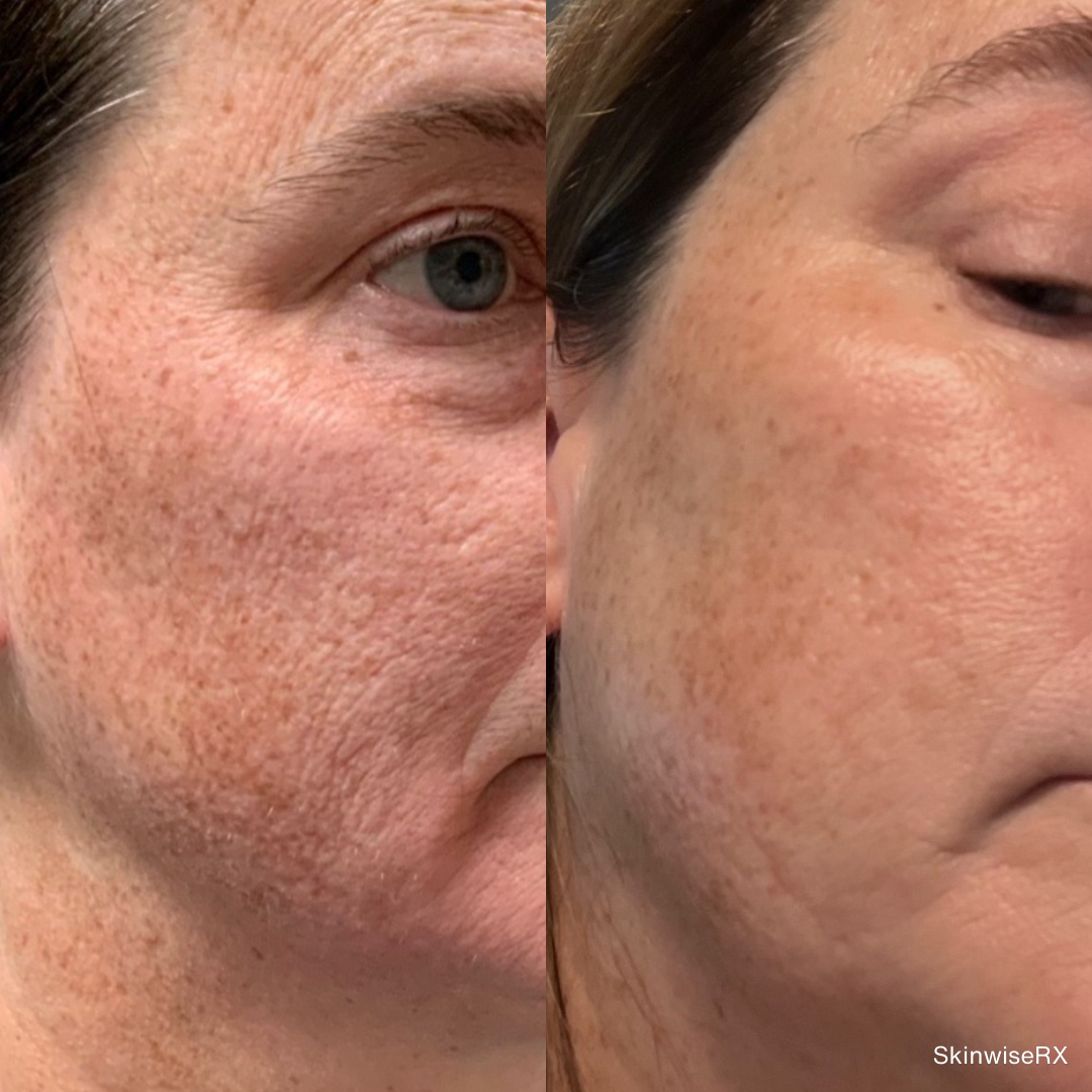 Before and after images showing improved skin texture and reduced redness on the face following PicoLazer treatment.