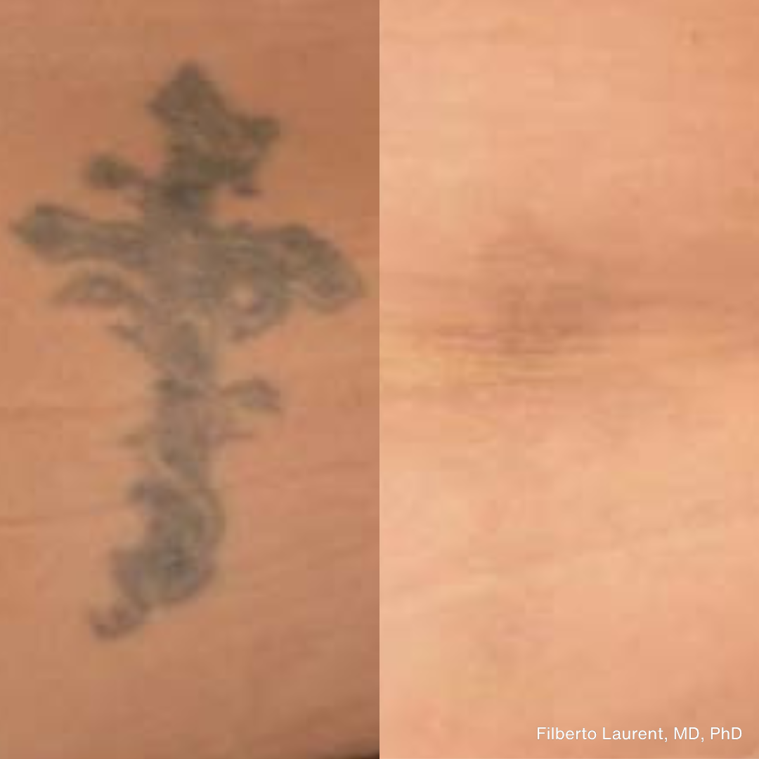 Before and after images showing the removal of a black tattoo using the PicoLazer device, with clear skin visible post-treatment.