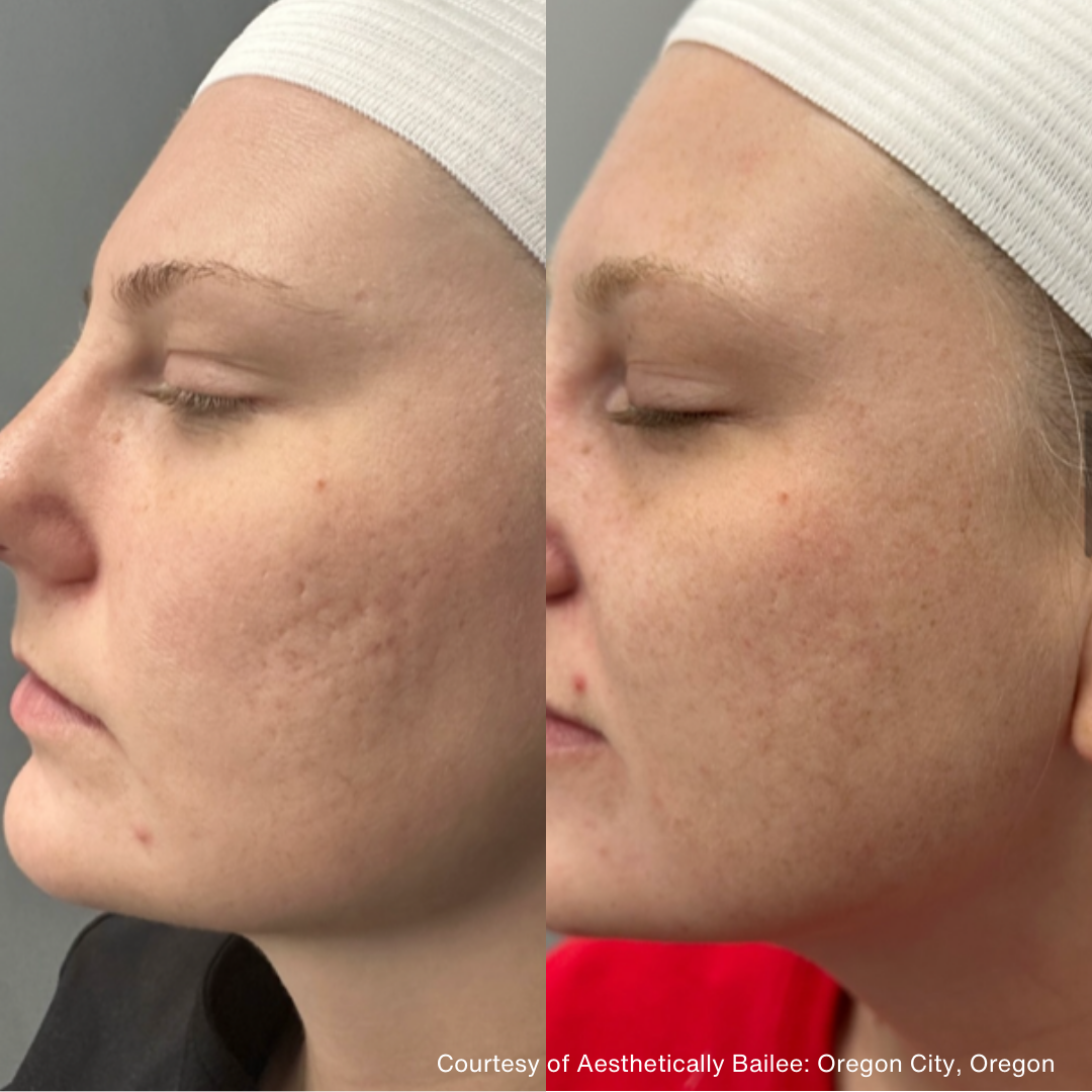 Before and after side profile images showing reduced acne scars and smoother skin texture following PiXel8-RF microneedling treatment.