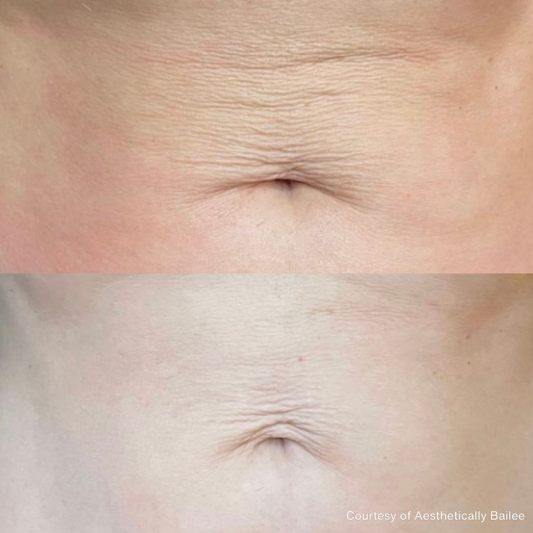 Before and after images showing reduced abdominal skin wrinkles and improved texture following PiXel8-RF microneedling treatment.