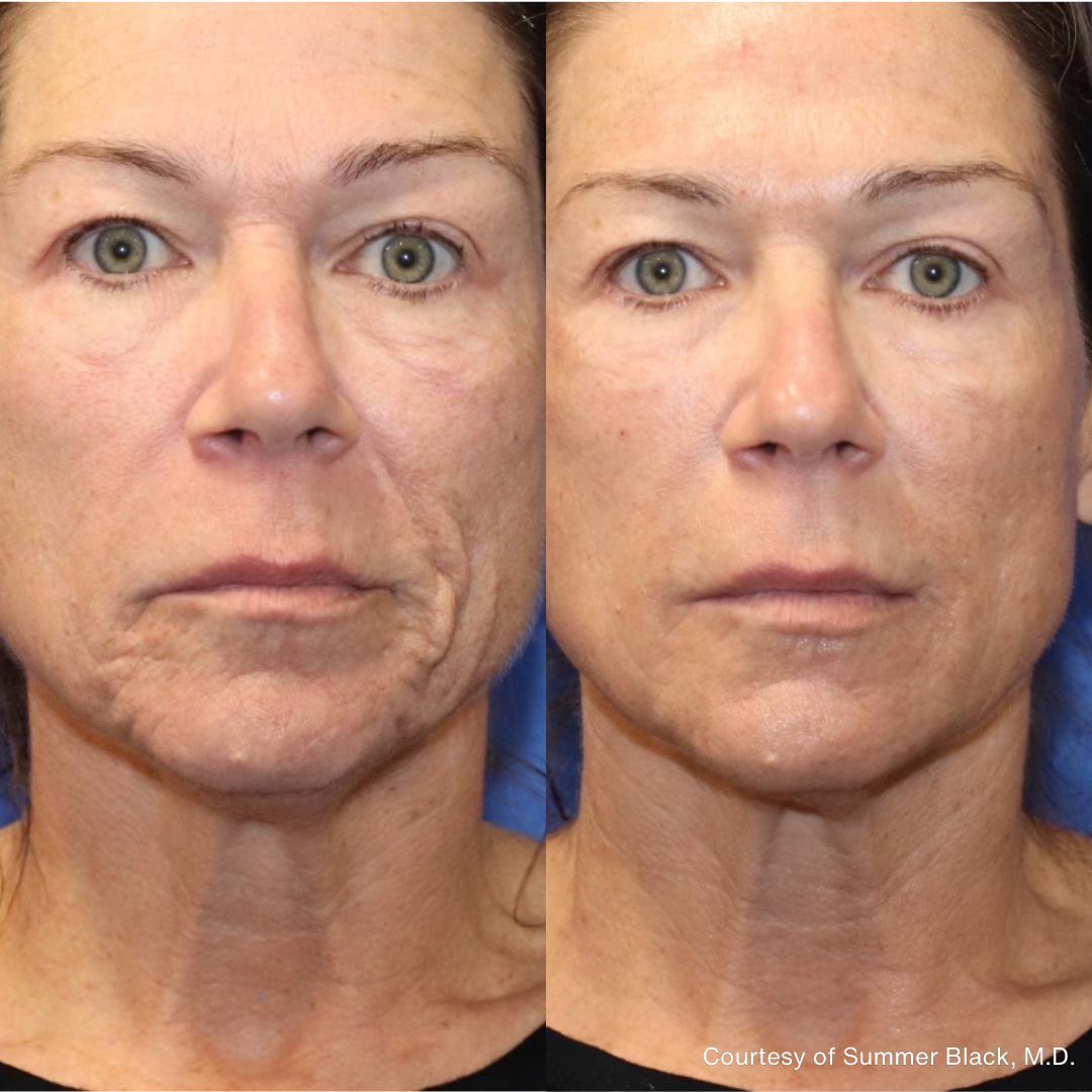 Before and after images showing smoother skin texture and reduced facial wrinkles following PiXel8-RF microneedling treatment.