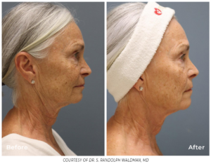 Side-by-side before and after images showing skin tightening and wrinkle reduction from PiXel8-RF microneedling treatment.