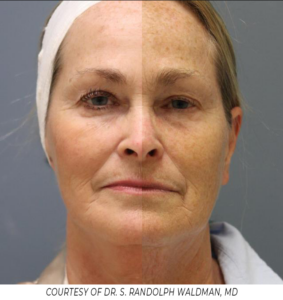 Side-by-side comparison of skin rejuvenation with PiXel8-RF microneedling, showing improved tone, texture, and firmness.