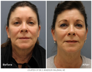Before and after images showing improved skin firmness, texture, and reduced wrinkles with PiXel8-RF microneedling treatment.