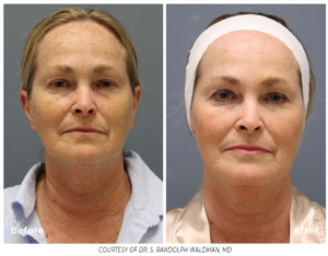Side-by-side comparison of skin rejuvenation with PiXel8-RF microneedling, showing improved tone, texture, and firmness.