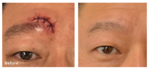 Before and after images showing significant scar reduction on the forehead with PiXel8-RF microneedling treatment.