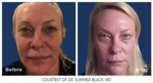 Frontal view before and after comparison of a woman's face treated with Spectrum, showing smoother skin and reduced facial redness.