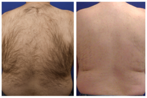 Back view before and after comparison showing hair removal results from Spectrum treatment, transitioning from a hairy back to smooth, hair-free skin.