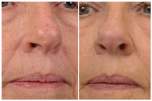 Close-up of the lower face before and after Spectrum treatment, showing reduced fine lines and improved skin texture around the mouth and cheeks.