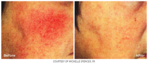 Close-up of an inflamed skin area before and after Spectrum treatment, showing reduced redness and smoother texture.