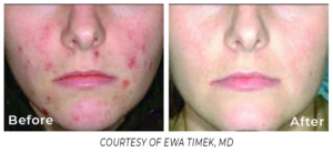 Close-up before and after comparison of a face with acne, showing fewer blemishes and clearer skin following Spectrum treatment.