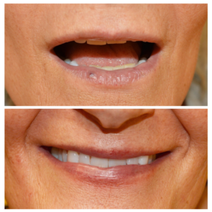 Close-up of the mouth area before and after Spectrum treatment, showing improved skin texture and reduced fine lines around the lips.