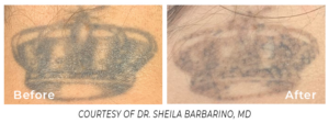 Before and after images of a tattoo removal treatment using Spectrum, showing significant fading of the tattoo.