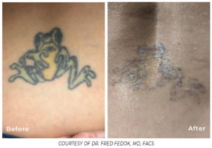 Before and after comparison of another tattoo removal using Spectrum, displaying near-complete tattoo removal and clear skin.