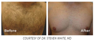 Close-up before and after comparison of a chest treated with Spectrum