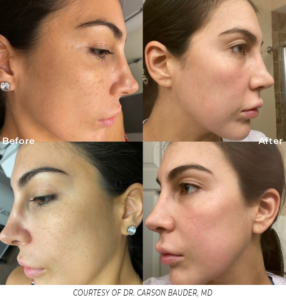 Close-up before and after comparison of a back treated with Spectrum, showing a reduction in pigmentation and smoother skin tone.