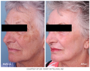 Profile view of an older woman's face before and after Spectrum treatment, showing fewer wrinkles and smoother skin.
