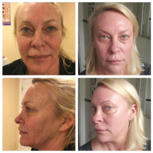 Multiple angles (front and profile) before and after comparison of a woman's face following Spectrum treatment, highlighting reduced facial redness, improved tone, and fewer fine lines.
