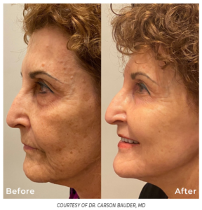 Profile view of an older woman's face before and after Phoenix treatment, showing smoother skin and fewer wrinkles around the jawline and cheek.