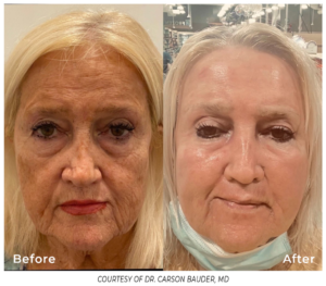 Frontal view of an older woman’s face before and after Phoenix treatment, highlighting significant reduction in facial redness, wrinkles, and improved skin clarity.
