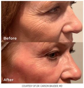 Close-up side view of the eye and cheek area before and after Phoenix treatment, highlighting the reduction of fine lines and improved skin tone.