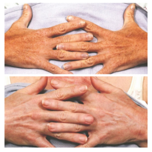 Comparison of hands before and after Phoenix treatment, showing decreased pigmentation and smoother skin appearance.