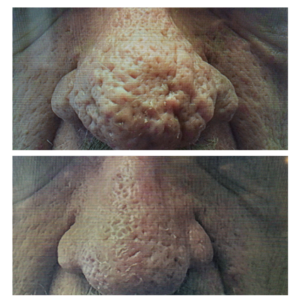 Close-up of a nose before and after Phoenix treatment, showing significant improvement in skin texture and reduced pore visibility.