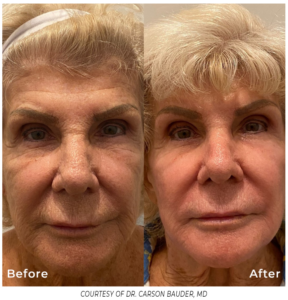 Frontal view of an older woman’s face before and after Phoenix treatment, showing improved skin tone, reduced redness, and fewer facial lines.