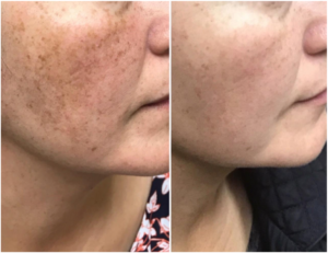 Before and after comparison of a person's cheek area treated with PicoLazer, showing reduced pigmentation and a more even skin tone.