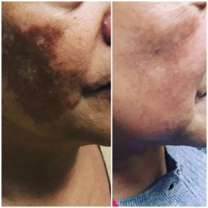 Before and after comparison of a cheek area with significant hyperpigmentation treated with PicoLazer, displaying a visible reduction in dark patches and improved skin clarity.