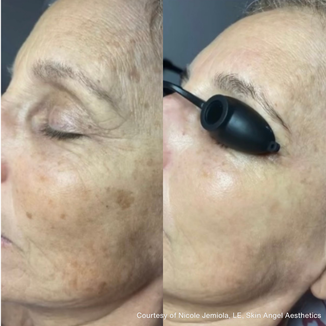 Before and after image showing skin rejuvenation with smoother texture and reduced fine lines on the face.