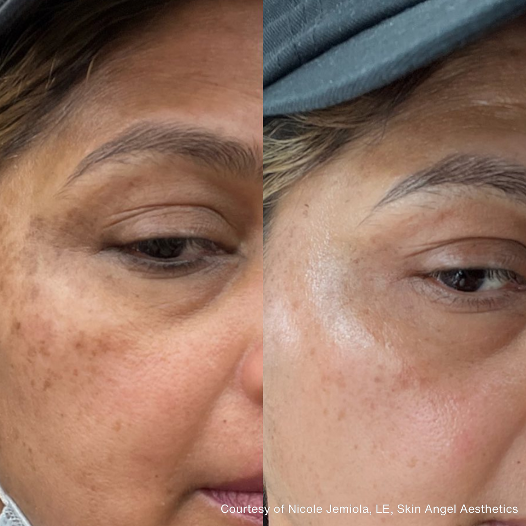 Before and after image showing reduced hyperpigmentation and improved skin tone around the eyes.