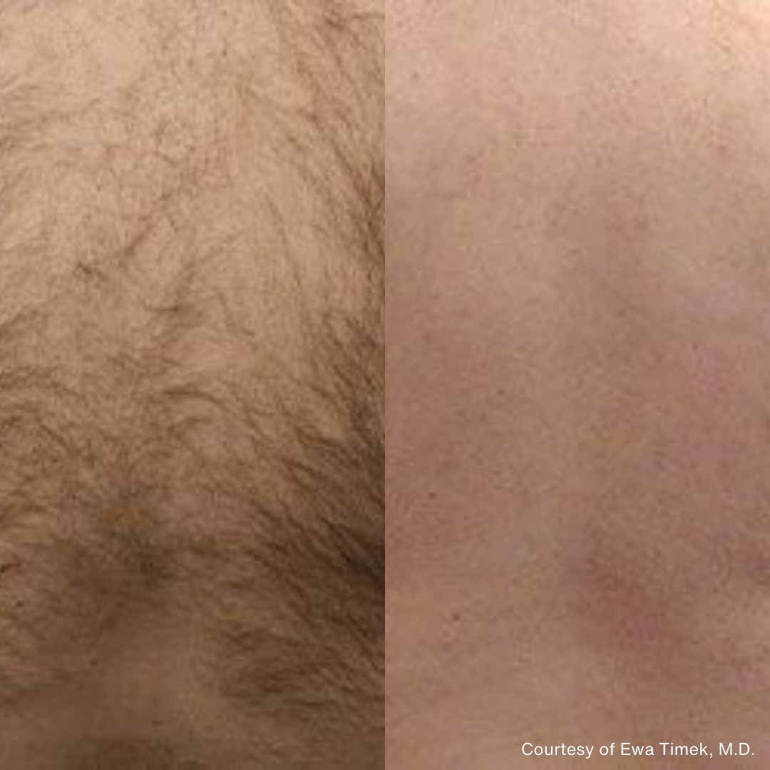 Before and after image showing hair removal treatment results with smooth, hair-free skin.