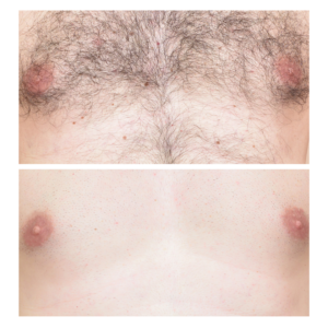 Before and after comparison of a chest area showing hair removal results with EpiLaze, displaying a transition from dense chest hair to a smooth, hair-free appearance.
