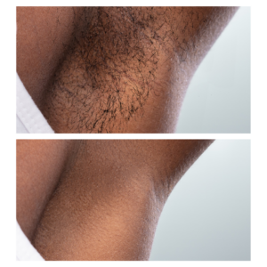 Before and after comparison of another underarm area treated with EpiLaze, highlighting the reduction of dense hair to a clean, hair-free surface.
