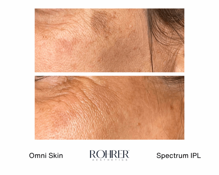 Spectrum Before and Afters - Rohrer Aesthetics