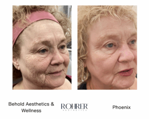 Side-by-side angled before and after photos of an older woman showing facial rejuvenation after Rohrer Phoenix treatment, with reduced wrinkles, smoother texture, and firmer skin.