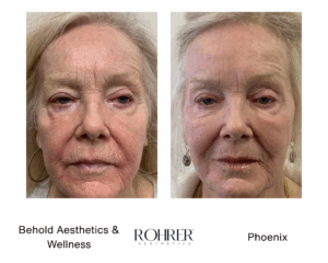 Side-by-side before and after photos of an older woman showing facial rejuvenation after Rohrer Phoenix treatment, with reduced fine lines, smoother skin texture, and improved tone.