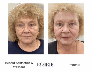 Side-by-side before and after photos of an older woman showing skin improvement after Rohrer Phoenix treatment, with reduced wrinkles, smoother texture, and more even skin tone.