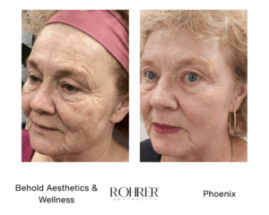 Side-by-side angled before and after photos of an older woman showing smoother skin, reduced wrinkles, and improved firmness following Rohrer Phoenix treatment.