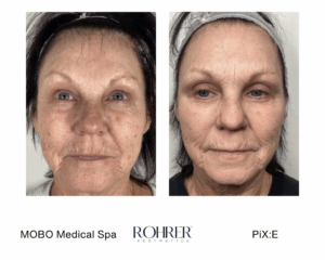 Before and after photos showing facial skin tightening after Rohrer Pix:E treatment.